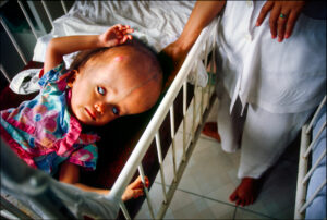 A Vietnamese child with hydracephalus is cared for at Tu Du Hospital, a research center in Ho Chi Minh City, Vietnam studying the effects of the chemical defoliant Agent Orange, which was widely sprayed by the United States during the Vietnam War.